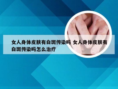 女人身体皮肤有白斑传染吗 女人身体皮肤有白斑传染吗怎么治疗