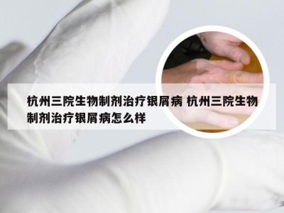 杭州三院生物制剂治疗银屑病 杭州三院生物制剂治疗银屑病怎么样