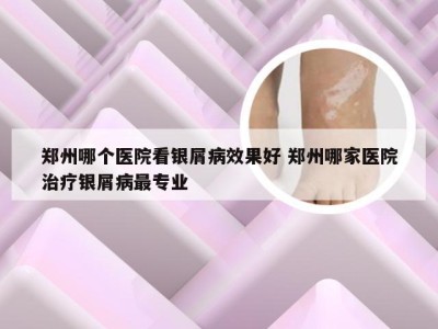 郑州哪个医院看银屑病效果好 郑州哪家医院治疗银屑病最专业