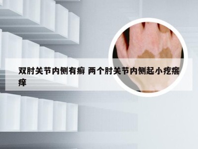 双肘关节内侧有癣 两个肘关节内侧起小疙瘩痒