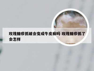 玫瑰糠疹抓破会变成牛皮癣吗 玫瑰糠疹抓了会怎样