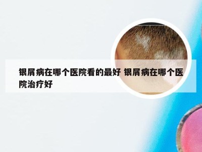 银屑病在哪个医院看的最好 银屑病在哪个医院治疗好