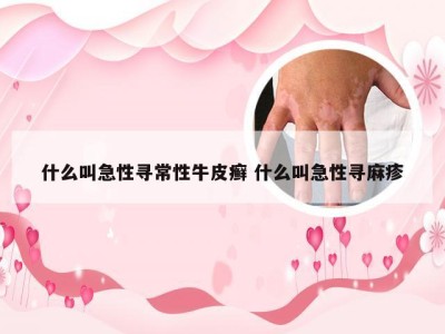 什么叫急性寻常性牛皮癣 什么叫急性寻麻疹