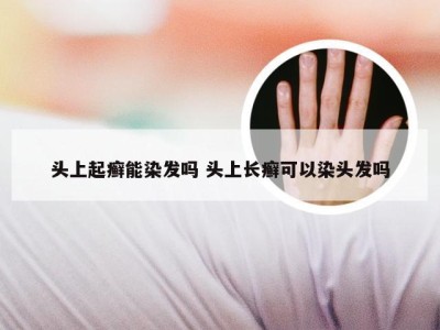 头上起癣能染发吗 头上长癣可以染头发吗