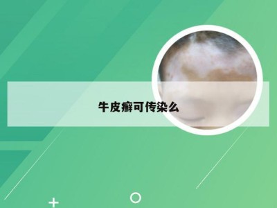 牛皮癣可传染么