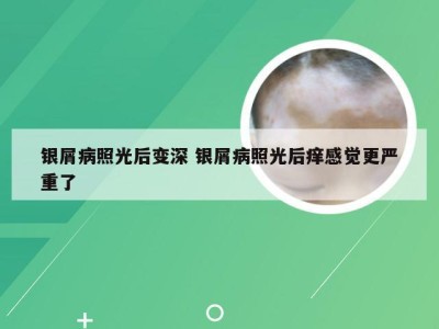 银屑病照光后变深 银屑病照光后痒感觉更严重了