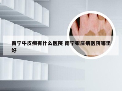 南宁牛皮癣有什么医院 南宁银屑病医院哪里好