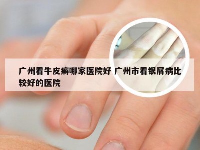 广州看牛皮癣哪家医院好 广州市看银屑病比较好的医院