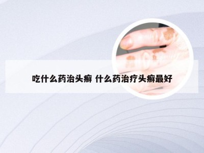 吃什么药治头癣 什么药治疗头癣最好