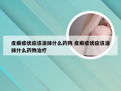 皮癣症状应该涂抹什么药物 皮癣症状应该涂抹什么药物治疗