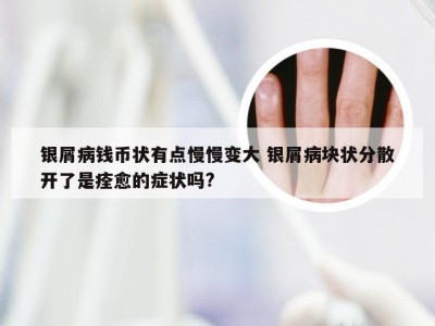 银屑病钱币状有点慢慢变大 银屑病块状分散开了是痊愈的症状吗?