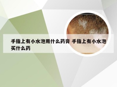 手指上有小水泡用什么药膏 手指上有小水泡买什么药