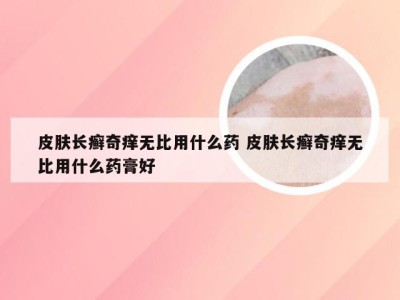 皮肤长癣奇痒无比用什么药 皮肤长癣奇痒无比用什么药膏好