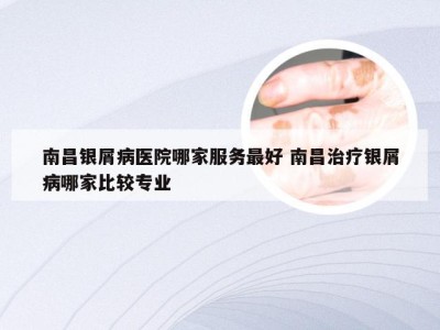 南昌银屑病医院哪家服务最好 南昌治疗银屑病哪家比较专业