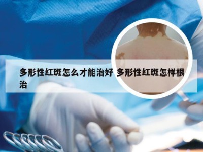 多形性红斑怎么才能治好 多形性红斑怎样根治