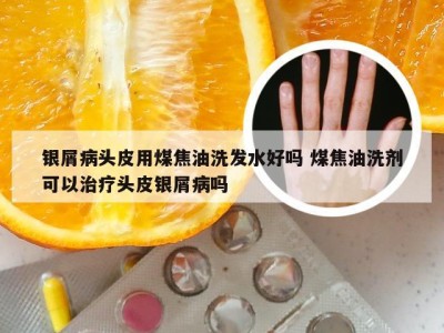 银屑病头皮用煤焦油洗发水好吗 煤焦油洗剂可以治疗头皮银屑病吗