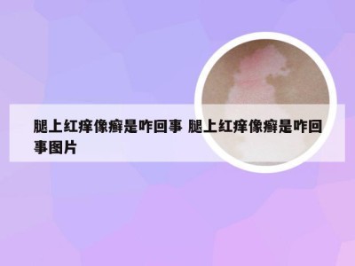 腿上红痒像癣是咋回事 腿上红痒像癣是咋回事图片