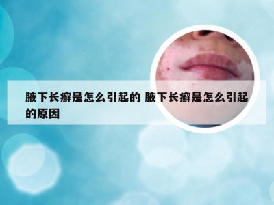 腋下长癣是怎么引起的 腋下长癣是怎么引起的原因