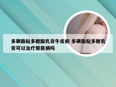 多磺酸粘多糖酸乳膏牛皮癣 多磺酸粘多糖乳膏可以治疗银屑病吗