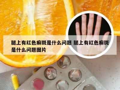 腿上有红色癣斑是什么问题 腿上有红色癣斑是什么问题图片