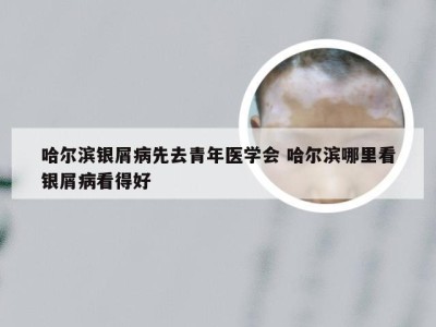 哈尔滨银屑病先去青年医学会 哈尔滨哪里看银屑病看得好