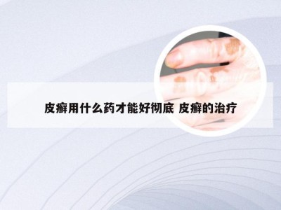 皮癣用什么药才能好彻底 皮癣的治疗