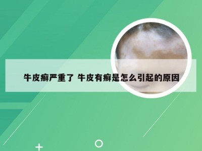 牛皮癣严重了 牛皮有癣是怎么引起的原因