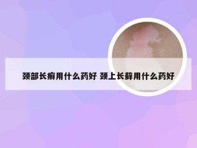 颈部长癣用什么药好 颈上长藓用什么药好