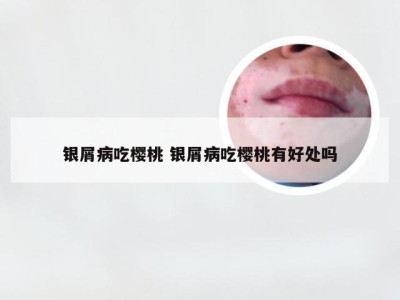 银屑病吃樱桃 银屑病吃樱桃有好处吗