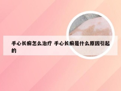 手心长癣怎么治疗 手心长癣是什么原因引起的