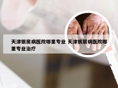 天津银屑病医院哪里专业 天津银屑病医院哪里专业治疗