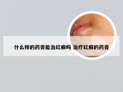 什么样的药膏能治红癣吗 治疗红癣的药膏