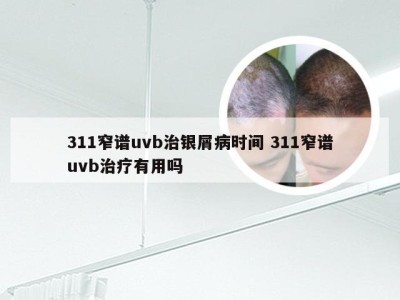 311窄谱uvb治银屑病时间 311窄谱uvb治疗有用吗