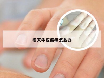 冬天牛皮癣痒怎么办