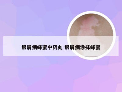 银屑病蜂蜜中药丸 银屑病涂抹蜂蜜