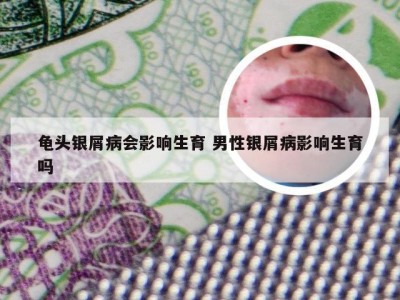 龟头银屑病会影响生育 男性银屑病影响生育吗