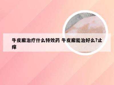 牛皮廨治疗什么特效药 牛皮廨能治好么?止痒