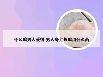 什么癣男人爱得 男人身上长癣用什么药