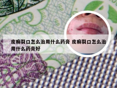 皮癣裂口怎么治用什么药膏 皮癣裂口怎么治用什么药膏好