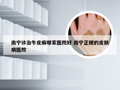 南宁诊治牛皮癣哪家医院好 南宁正规的皮肤病医院