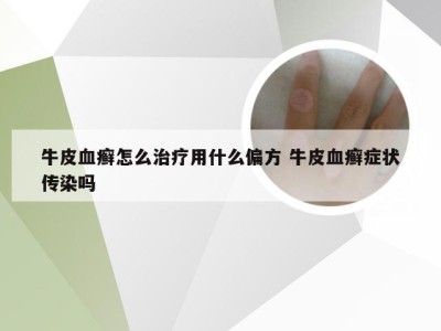 牛皮血癣怎么治疗用什么偏方 牛皮血癣症状传染吗