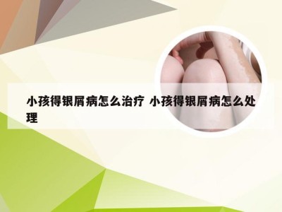 小孩得银屑病怎么治疗 小孩得银屑病怎么处理