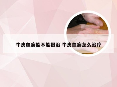 牛皮血癣能不能根治 牛皮血癣怎么治疗