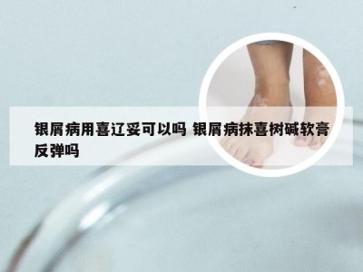 银屑病用喜辽妥可以吗 银屑病抹喜树碱软膏反弹吗