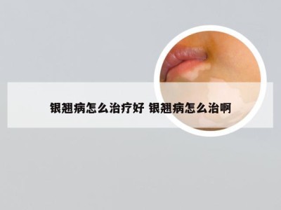 银翘病怎么治疗好 银翘病怎么治啊