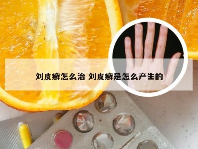 刘皮癣怎么治 刘皮癣是怎么产生的