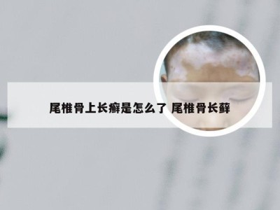 尾椎骨上长癣是怎么了 尾椎骨长藓