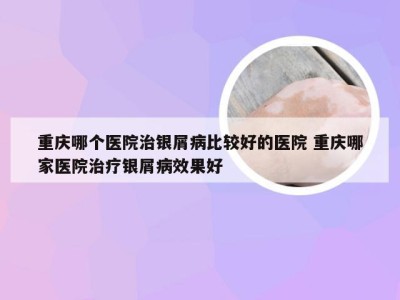 重庆哪个医院治银屑病比较好的医院 重庆哪家医院治疗银屑病效果好