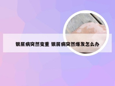 银屑病突然变重 银屑病突然爆发怎么办