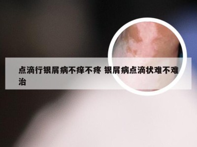 点滴行银屑病不痒不疼 银屑病点滴状难不难治